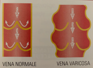 vena varicosa